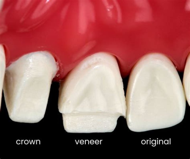 Are jacket crowns permanent?