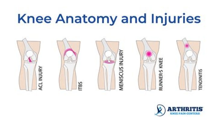 Are knee dislocations serious?