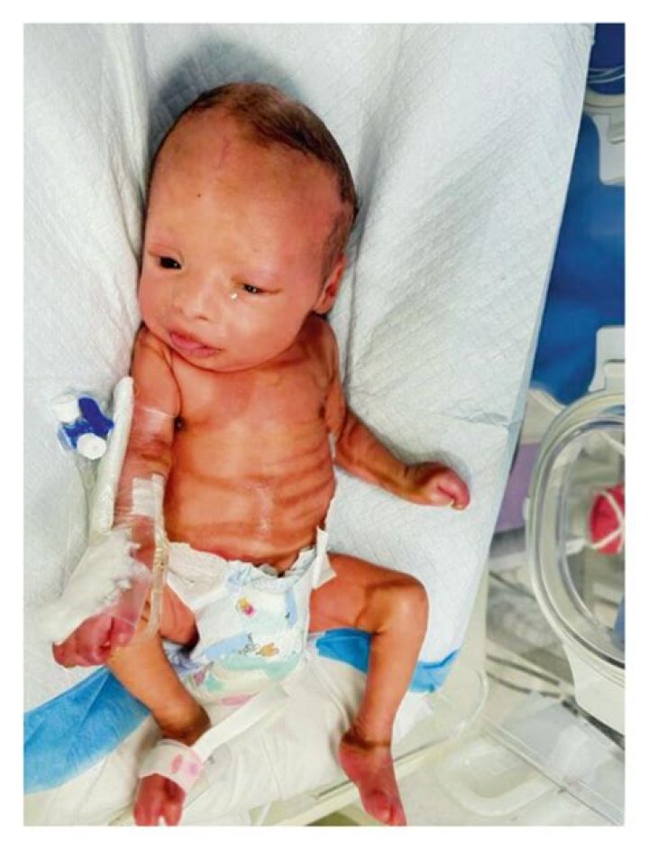 Can a baby survive harlequin ichthyosis?