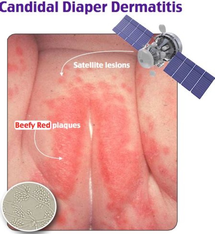 Can baby get diaper rash on labia?