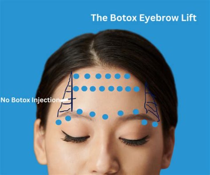 Can Botox lift eyebrows UK?