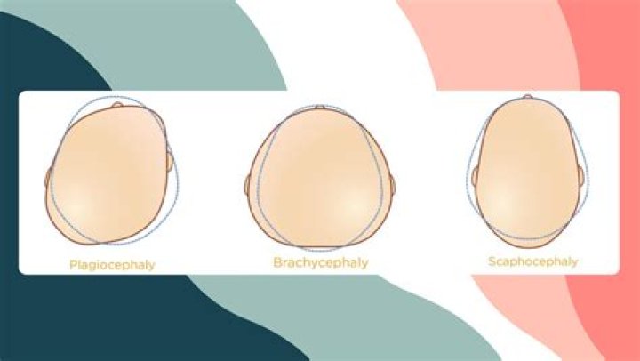 Can Brachycephaly correct itself?