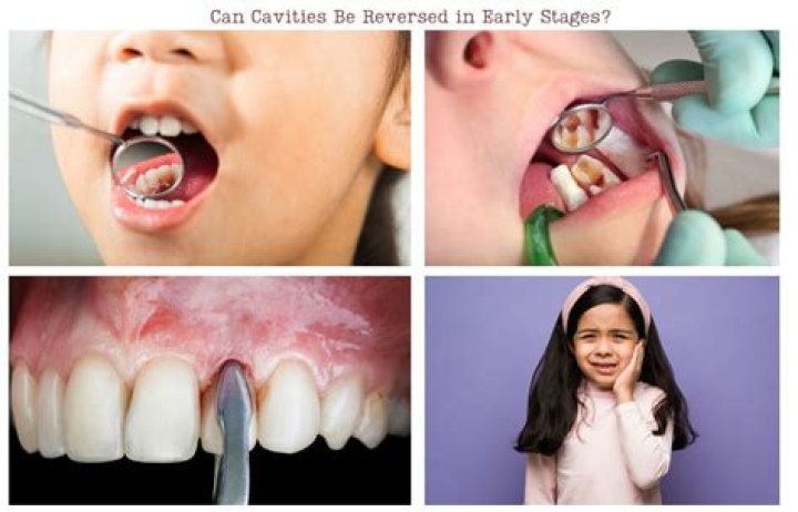Can cavities be reversed in toddlers?