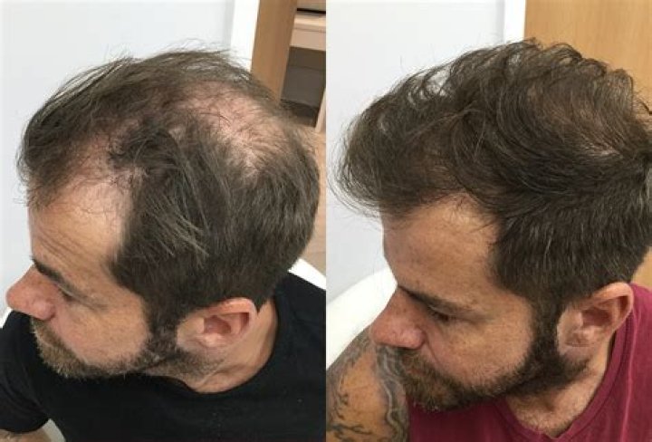 Can finasteride fix a receding hairline?