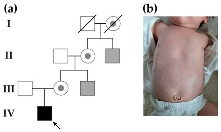Can girls get X-linked ichthyosis?
