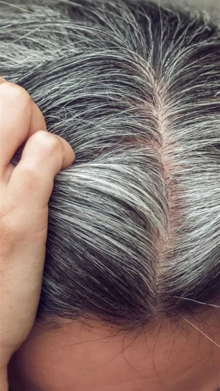 Can premature Greying of hair be cured?
