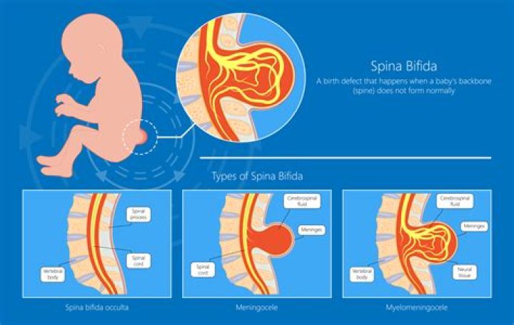 Can spina bifida cause arthritis?