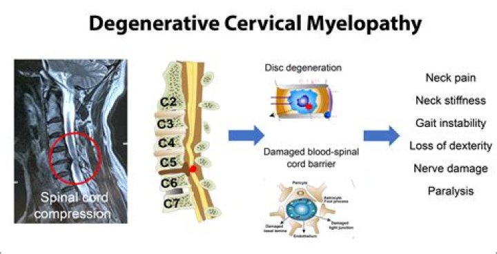 Can thoracic myelopathy cure?