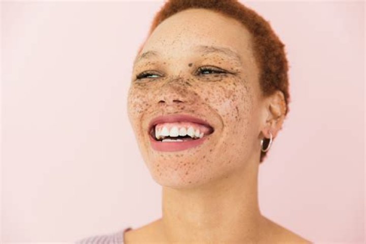 Can you get freckles anywhere?
