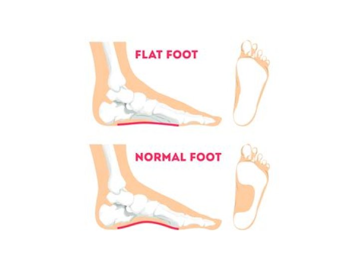 Can you get medically discharged for flat feet?