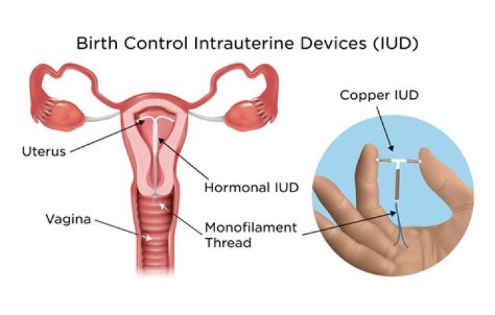 Can you insert IUD with bacterial vaginosis?