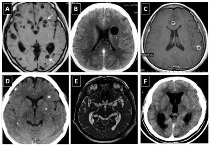Can you see a cholesteatoma on CT scan?