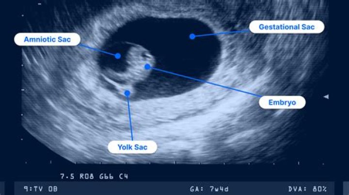Can you see a heartbeat at 6 weeks IVF?