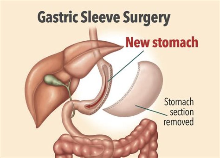 Can you take steroids after gastric sleeve surgery?