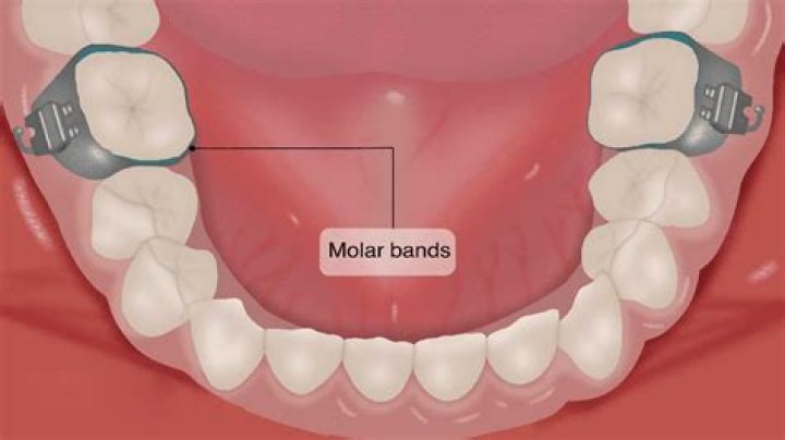 Do you get brackets on your molars?