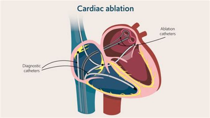 Does cardiac ablation shorten your life?