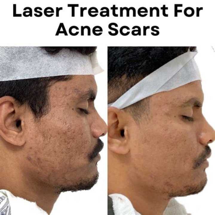 Does fractional laser work for acne scars?