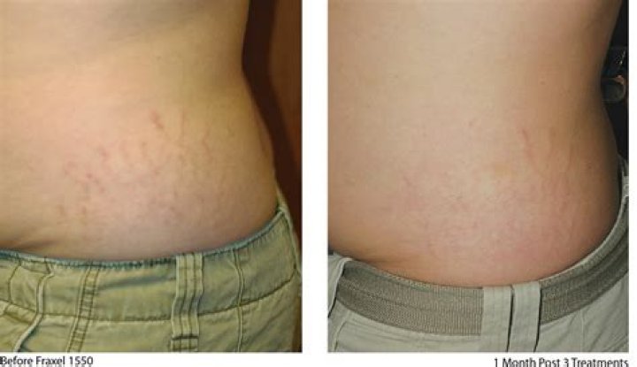 Does Fraxel laser remove stretch marks?