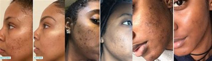 Does kojic really whitens skin?