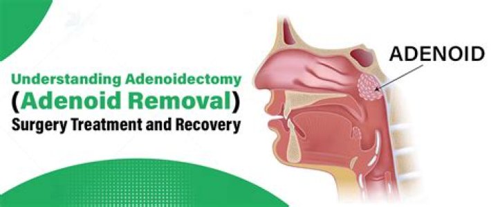 Does removing adenoids cause any problems?