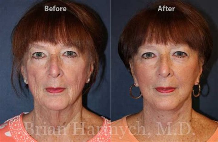 Does ultrasound facelift work?