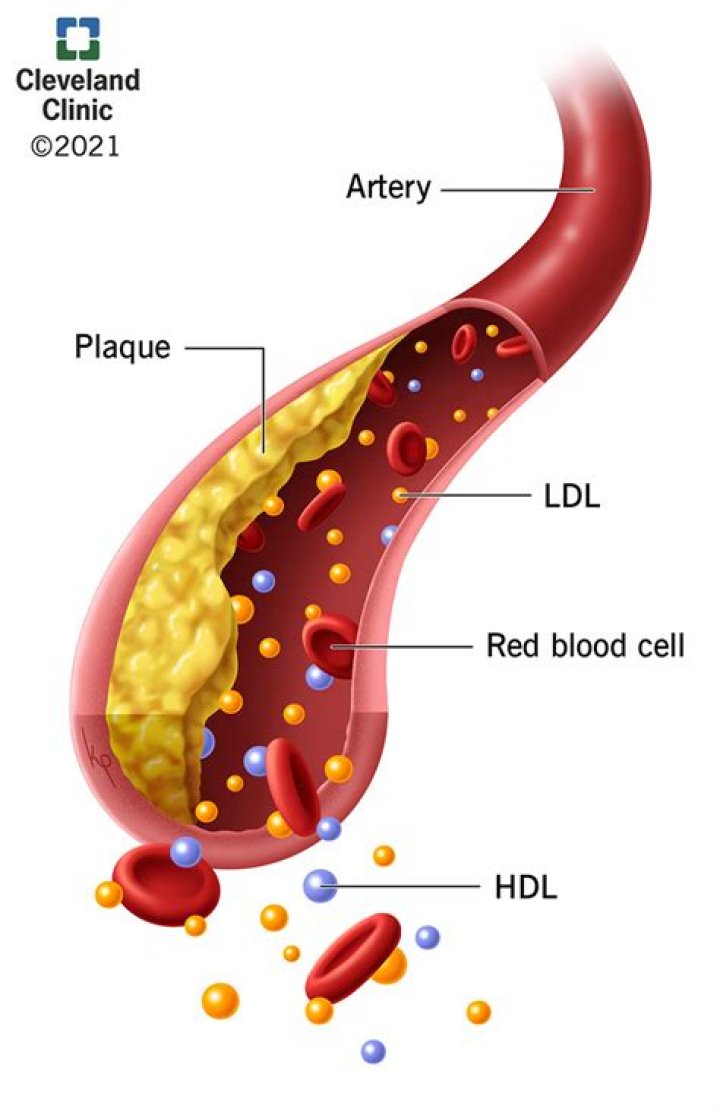 How do you diagnose dyslipidemia?