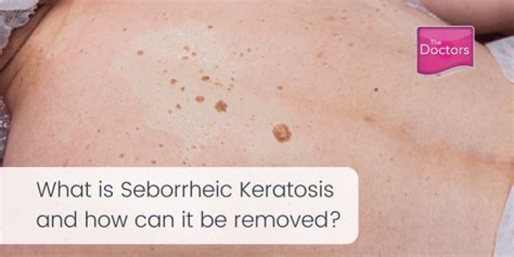 How do you dissolve seborrheic keratosis?