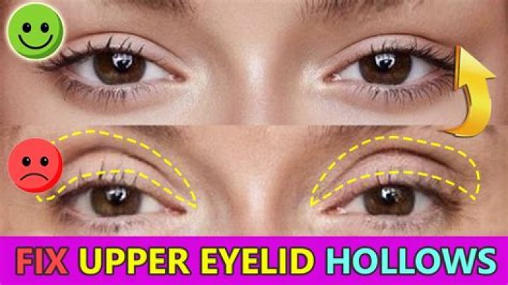 How do you fix Crepey eyelids?