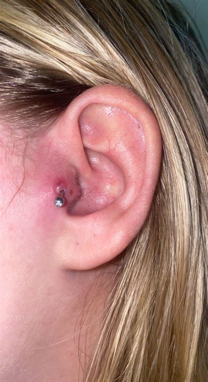 How do you get rid of an infected tragus piercing?