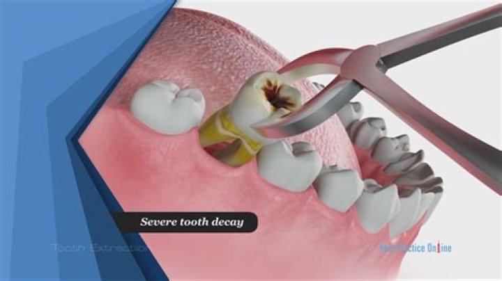 How do you pull a tooth out with a thread?