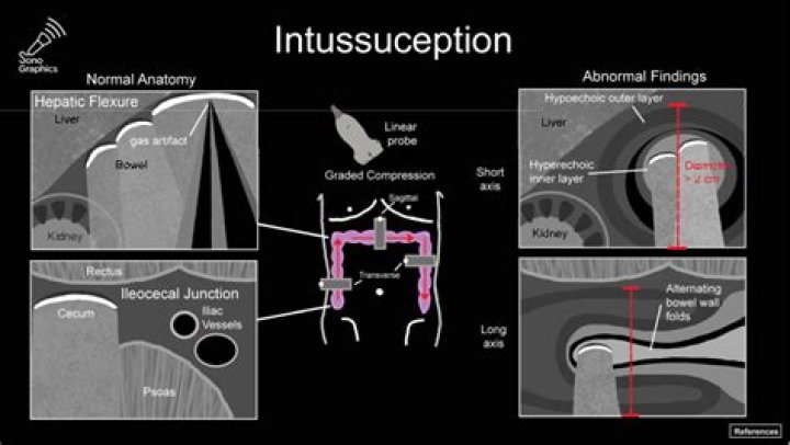 How do you rule out intussusception?