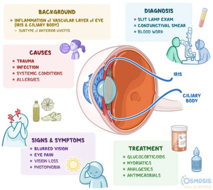 How do you test for anterior uveitis?