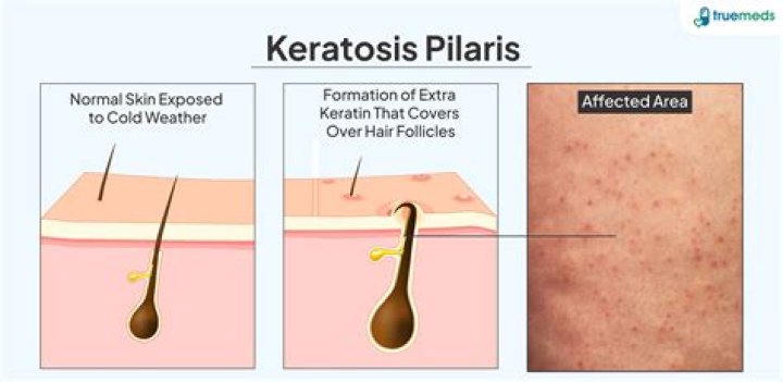 How do you treat keratosis pilaris rubra?