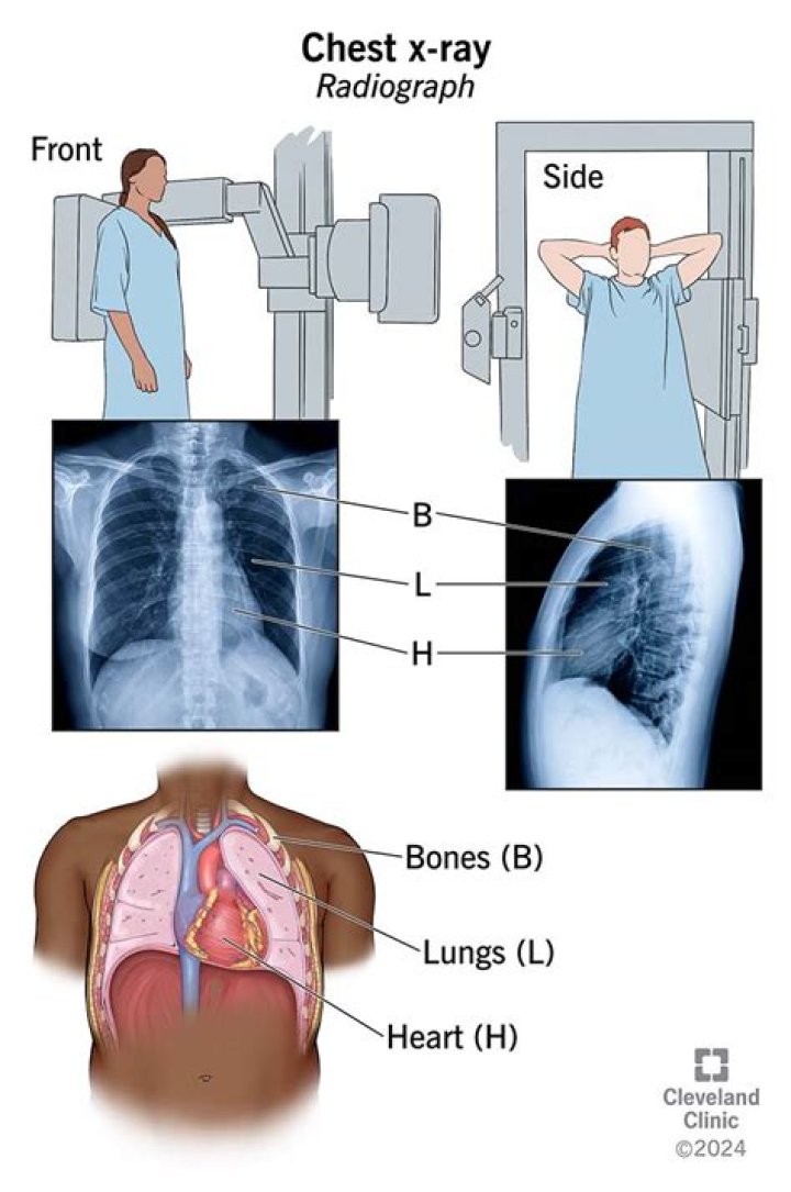 How does a chest X-ray detect a pneumothorax?