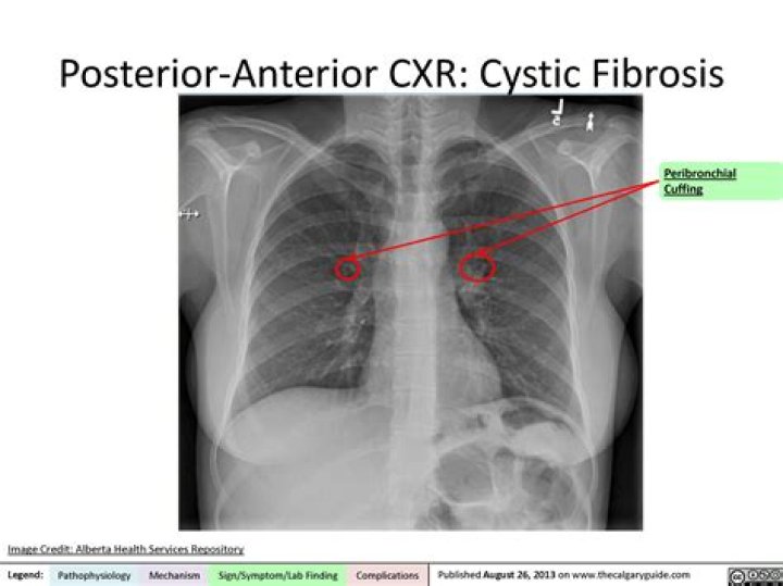 How does cystic fibrosis appear on x-ray?