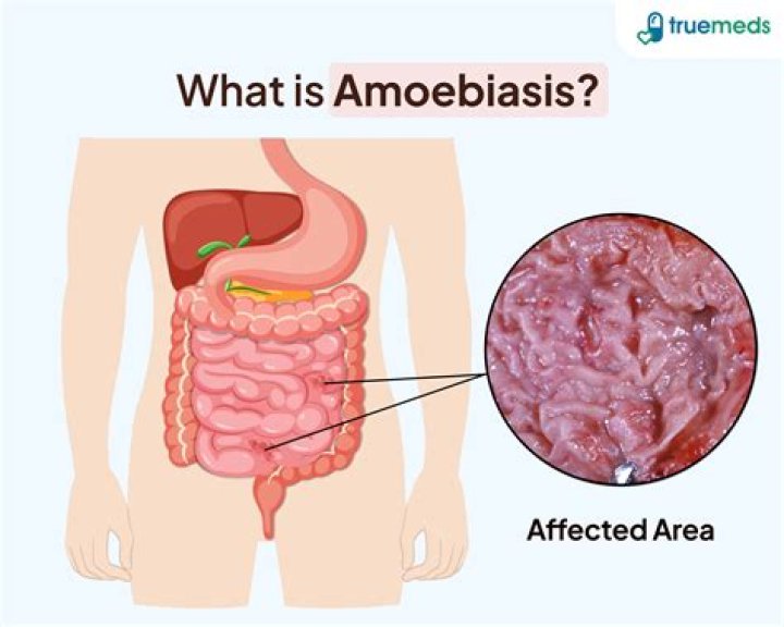 How is amebiasis diagnosed?