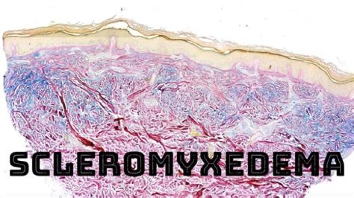 How is scleromyxedema diagnosed?