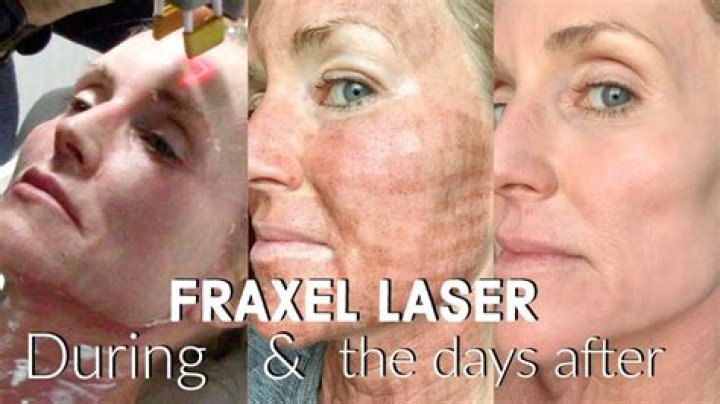How long after Fraxel do you see results?