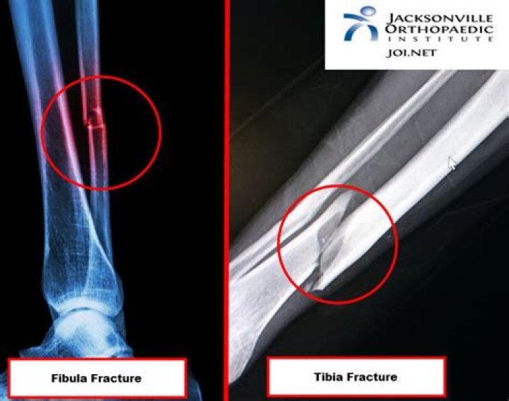 How long does a distal fibula fracture take to heal?