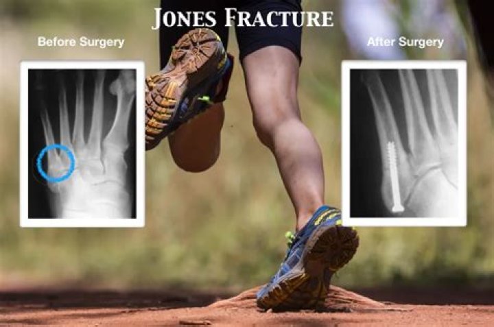 How long was Kevin Durant out with a Jones fracture?