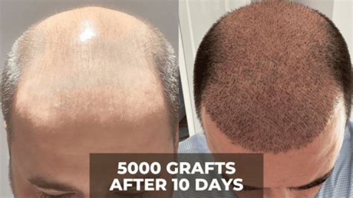 How much area does 3000 grafts cover?