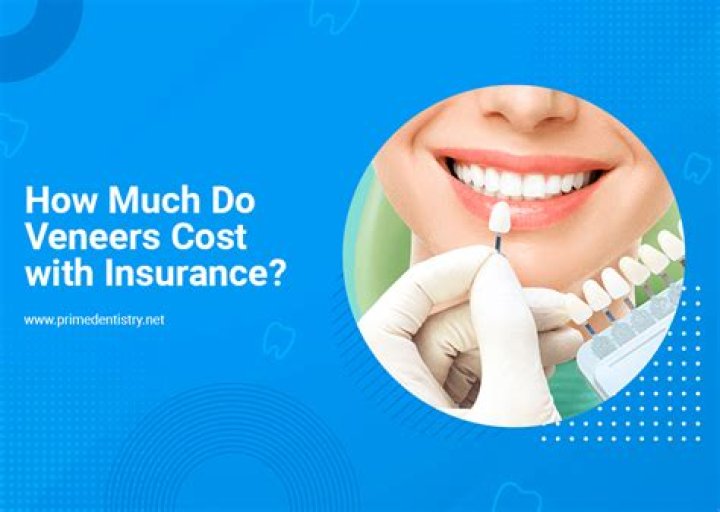 How much do labial veneers cost?