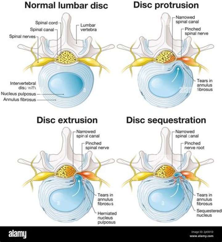 How serious is a disc protrusion?