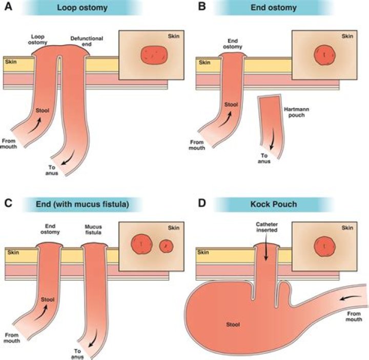 How successful are ileostomy reversals?
