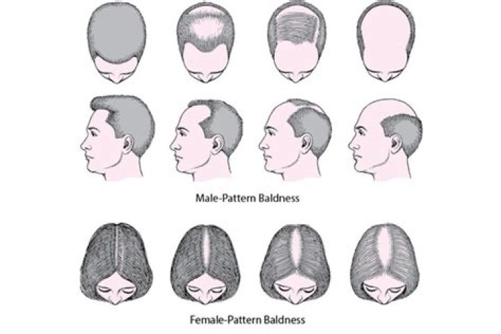 Is baldness on the X chromosome?
