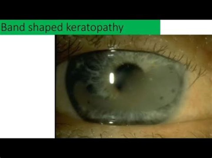 Is band keratopathy treatable?