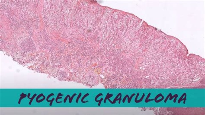 Is eosinophilic granuloma painful?