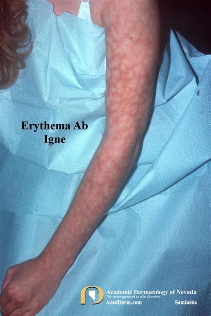 Is erythema ab igne serious?