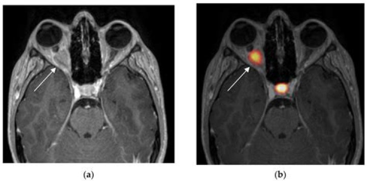 Is meningioma considered a disability?