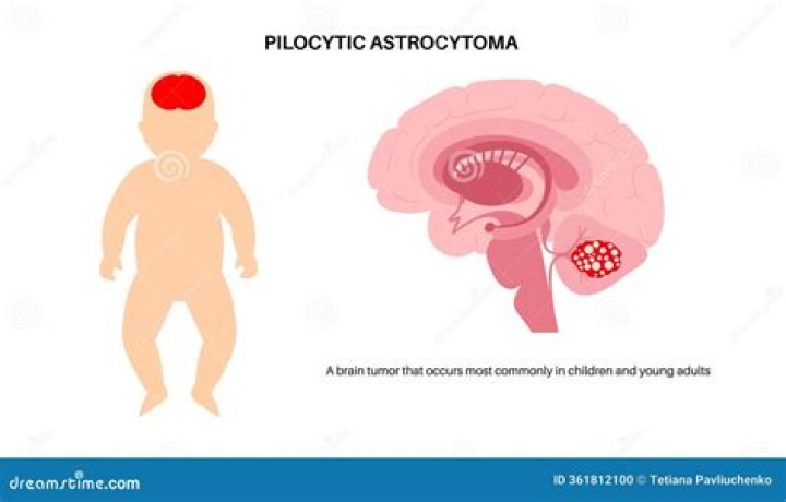 Is pilocytic astrocytoma curable?